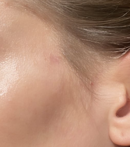 Tronque Scar Concentrate view 4