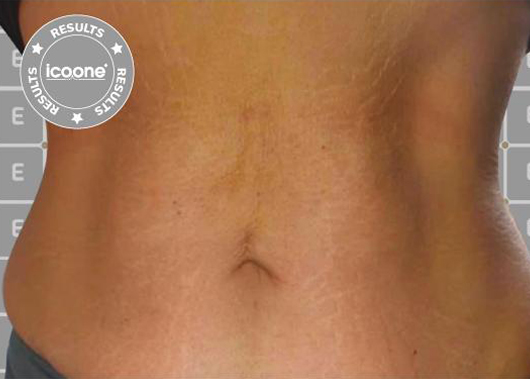 Icoone Body Treatment After