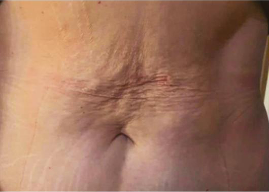 Icoone Body Treatment Before